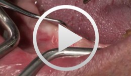 3D planning and template-guided implant insertion in the edentulous jaw