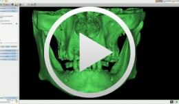 3D-Planung und schablonengeführte Implantation im teilbezahnten Kiefer