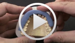 Immediate placement and all-ceramic restoration in the anterior maxilla - a customized interdisciplinary treatment approach - Laboratory work