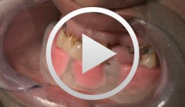 3D planning and template-guided implant insertion in the edentulous jaw