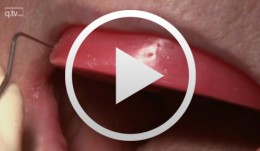 Implant-supported removable restorations in the edentulous jaw