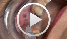 Innovative CAD/CAM treatment approaches for implant-supported fixed restorations