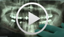 Rationelle Implantation (Einzelimplantat in 20 Min.)