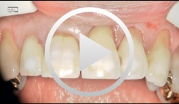 OsseoSpeed Profiles TX - Immediate placement and restoration - Facial defect and recession