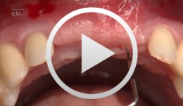 Peri-implant soft tissue management at the second stage surgery in the esthetic zone