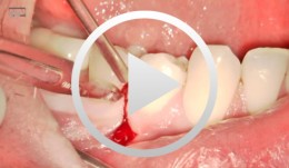 Microsurgical apical resection