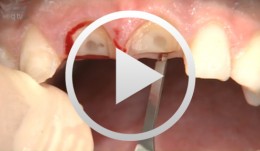 Socket-shield surgery on two central incisors