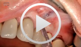 Microsurgical apical resection on a maxillary premolar