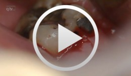 Implantation im unteren Seitenzahnbereich und sofortige provisorische Versorgung