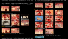 VERTICAL AND HORIZONTAL RIDGE AUGMENTATION USING TITANIUM MESH AND AUTOGENOUS BLOCK BONE