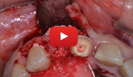 Treatment of a fenestration defect with GBR and CT graft