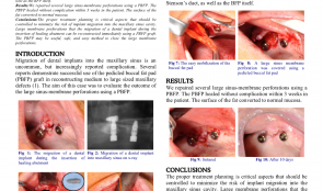 CLOSURE OF LARGE PERFORATIONS OF SINUS MEMBRANE USING A PEDICLED BUCCAL FAT PAD (PBFP) GRAFT