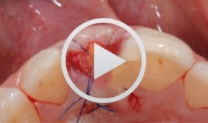 Soft Tissue Management in the Aesthetic Zone