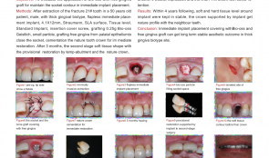 APPLICATION OF BIO-OSS WITH FREE GINGIVA GRAFT FOR MAINTAINING SOCKET CONTOUR IN IMMEDIATE IMPLANT PLACEMENT
