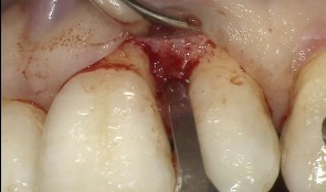 Study Protocols: Periodontal Regeneration 