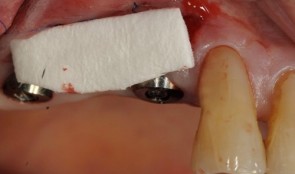 Study Protocols: Soft-Tissue Augmentation 