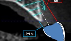 Study Protocols: Horizontal Ridge Augmentation 