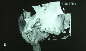 Study Protocols: Vertical Ridge Augmentation 