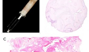 Study Protocols: Maxillary Sinus Floor Elevation 