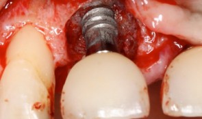 Study Protocols: Treatment Of Peri-Implantitis 