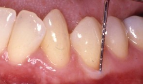 Study Protocols: Regeneration Of Keratinized Gingiva 