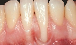 Study Protocols: Root Coverage Regeneration 