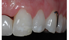 Transitional restorations at implant sites
