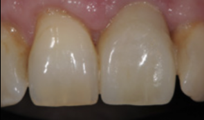 Case report - Immediate Smile® featuring ATLANTIS Abutment