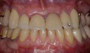 Tendency of skeletal class 3 and a missing front tooth