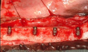 Horizontal Ridge Augmentation