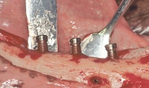 Vertical Ridge Augmentation