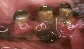 Peri-implantitis Defect