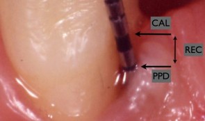Endpoints In Oral And Maxillofacial Regeneration Clinical Trials 