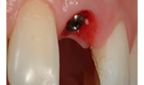 Immediate implant placement -factors influencing the esthetic success