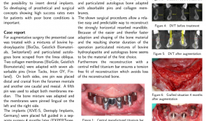 SURGICAL AND PROSTHETIC RESTORATION OF HORIZONTAL RESORBED EDENTULOUS MANDIBLE—A CASE REPORT