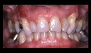 Periodontitis case, fixed reconstructions on teeth, implants and tooth-implant combination 