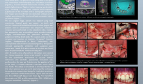 REHABILITATION OF A FIBULA-RECONSTRUCTED MANDIBLE BY USING COMPUTER ASSISTED IMPLANT SURGERY.  A CASE REPORT.