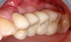 Conventional sinus floor elevation with a new biphasic bone graft material and a slow-resorbing collagen membrane
