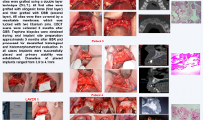 EVALUATION OF A DOUBLE-LAYER TECHNIQUE (DLT) FOR ENHANCING BONE FORMATION IN ATROPHIC MAXILLARY ALVEOLAR RIDGES