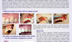 PREDICTIVE VALUE OF CYTOKINES (IL-1β, IL-6, TNF-α), MMP-9 AND uPA  and uPAR GENE POLYMORPHISMS FOR CLINICAL OUTCOMES OF GINGIVAL RECESSION