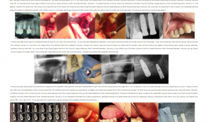 THE USE OF BIOACTIVE GLASS AS BONE SUBSTITUTE IN ORAL IMPLANTOLOGY—A CASE SERIES