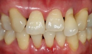 After periodontal therapy an anterior implant supported crown was planed
