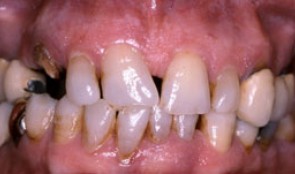 Periodontitis case, fixed reconstructions on teeth and implants