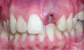 Single implant crown in the esthetic zone