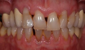 Esthetic improvement in patient with periodontitis