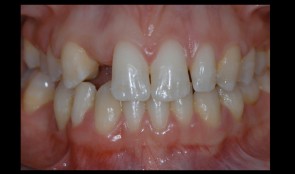 Rehabilitation of a patient with hypodontia