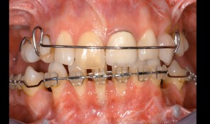 Comprehensive treatment of a patient with tooth agenesis