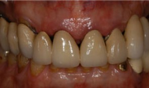 Replacement of a FPD (12-24) in a multimorbid patient