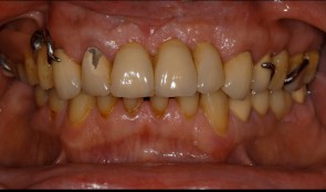 Replacement of a functional displeasing prosthesis in the maxilla