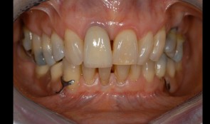 Fixed restoration to reestablish masticatory performance